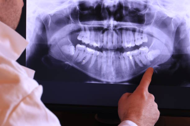 Best Dental Abscess Treatment in Lyons, CO